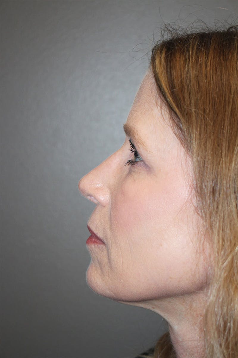 Rhinoplasty Before & After Gallery - Patient 146669314 - Image 8