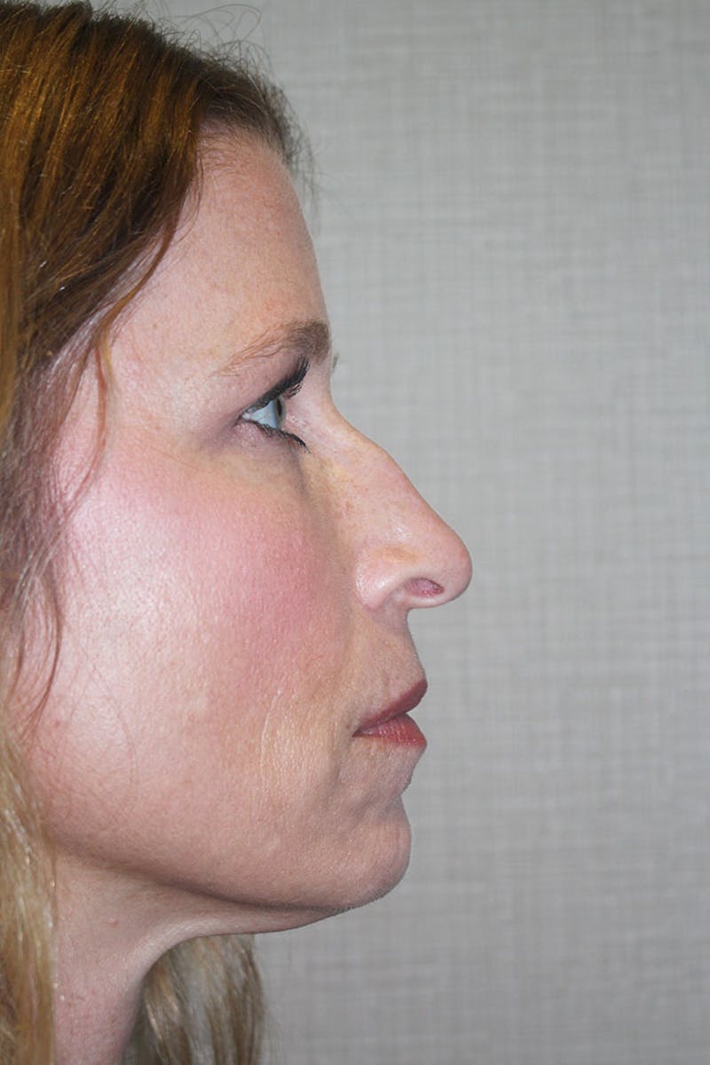 Eyelid surgery Before & After Gallery - Patient 146669147 - Image 7
