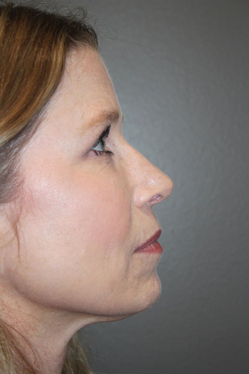 Rhinoplasty Before & After Gallery - Patient 146669314 - Image 2