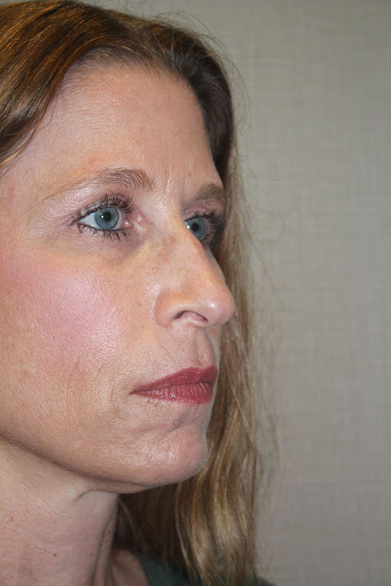Chemical Peel Before & After Gallery - Patient 146669152 - Image 9