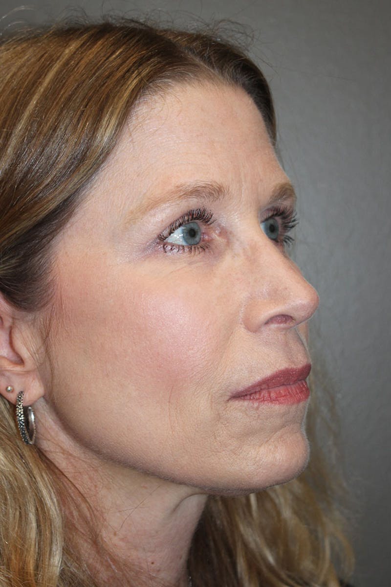 Eyelid surgery Before & After Gallery - Patient 146669147 - Image 10