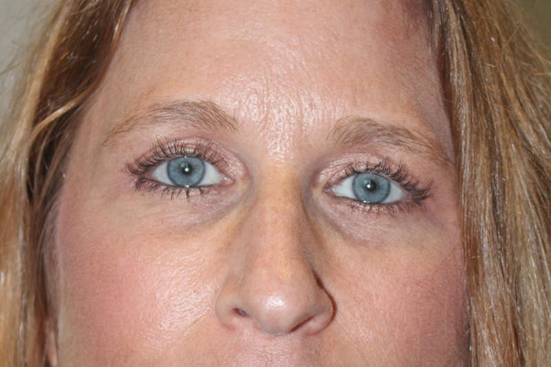 Eyelid surgery Before & After Gallery - Patient 146669147 - Image 11