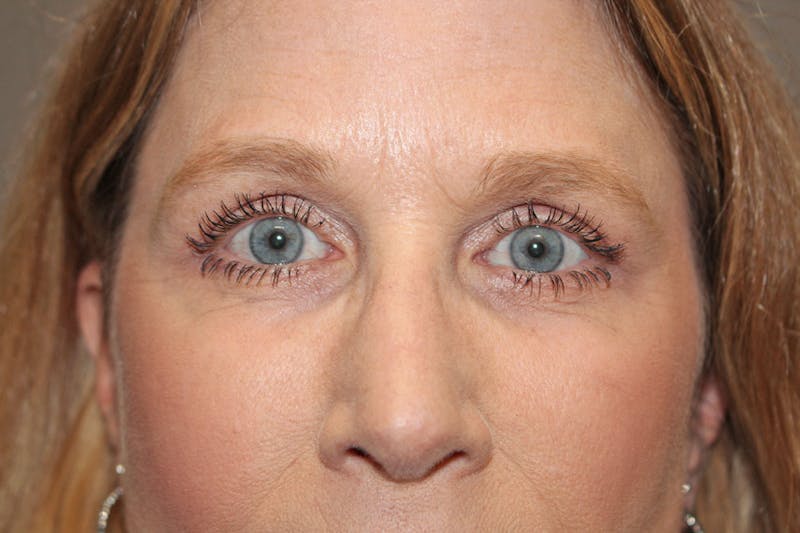 Eyelid surgery Before & After Gallery - Patient 146669147 - Image 12