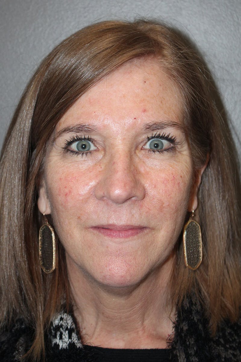 Chemical Peel Before & After Gallery - Patient 146669153 - Image 1