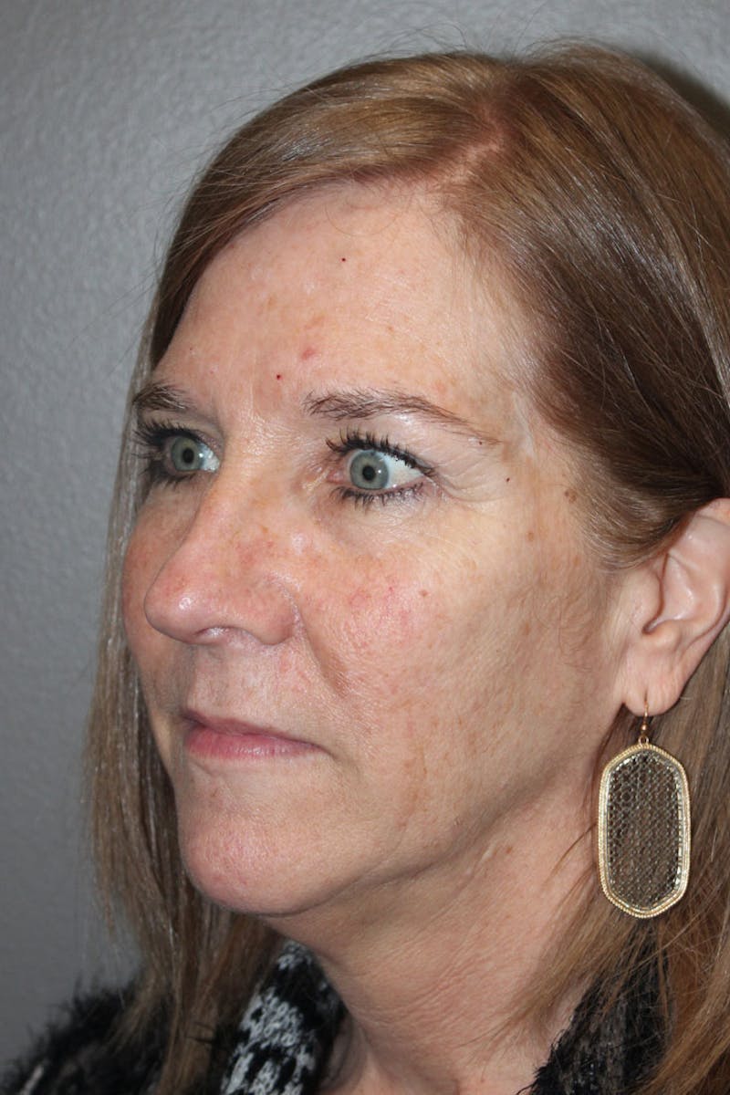 Chemical Peel Before & After Gallery - Patient 146669153 - Image 3
