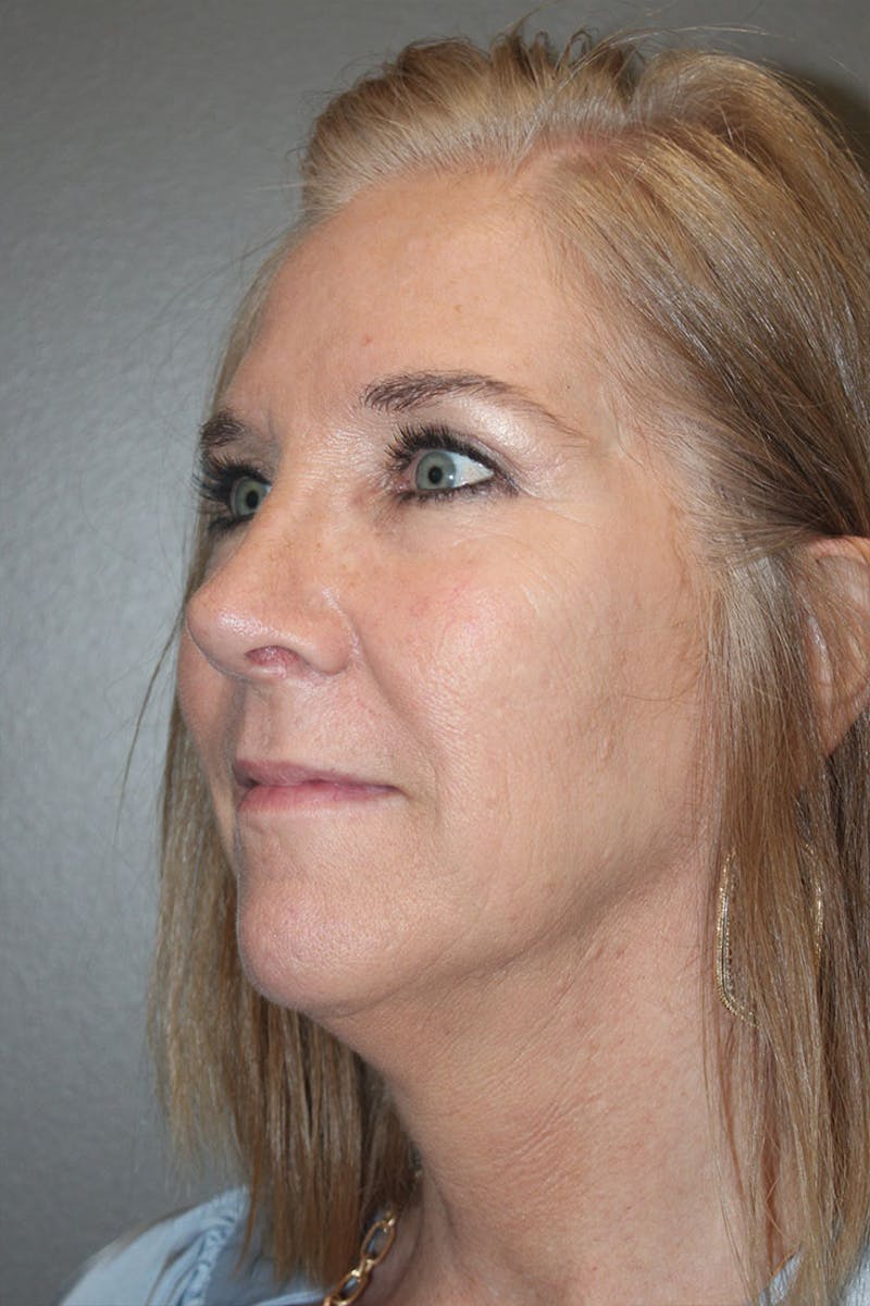 Eyelid surgery Before & After Gallery - Patient 146669148 - Image 4