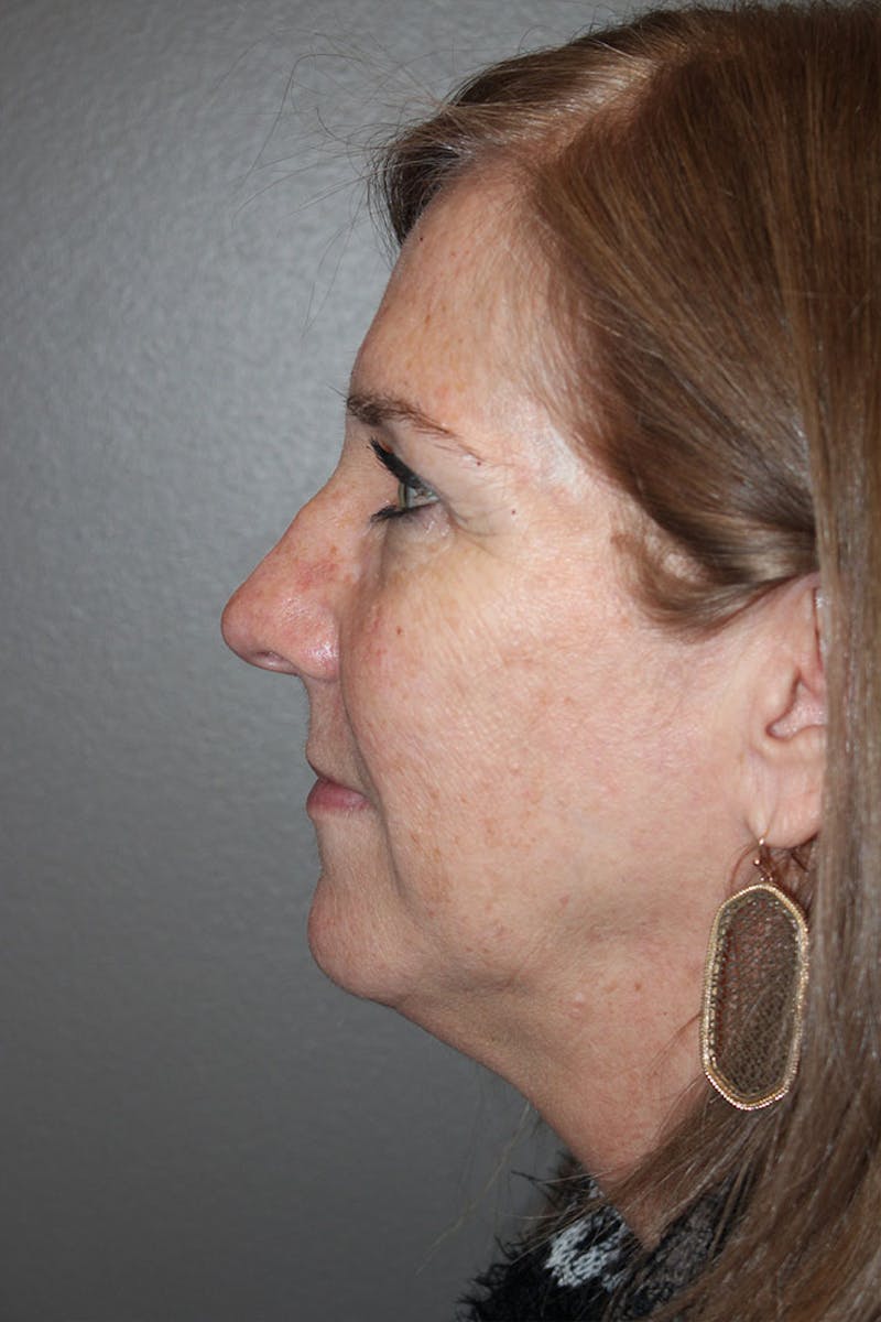 Eyelid surgery Before & After Gallery - Patient 146669148 - Image 5
