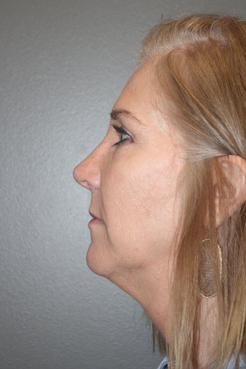 Eyelid surgery Before & After Gallery - Patient 146669148 - Image 6