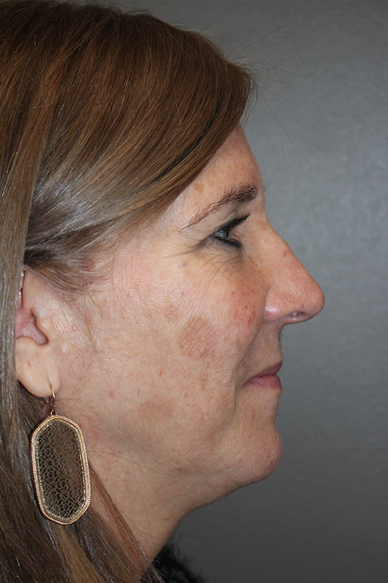 Rhinoplasty Before & After Gallery - Patient 146669561 - Image 1