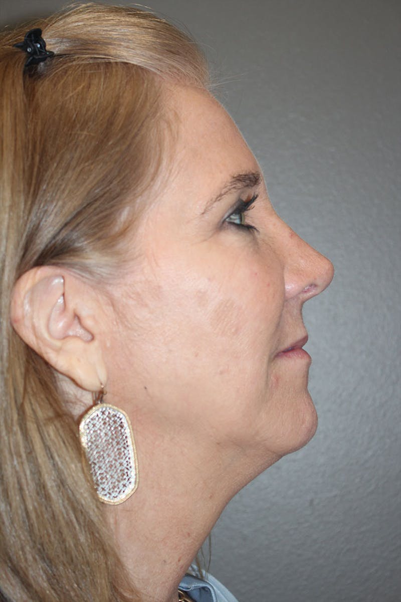 Chemical Peel Before & After Gallery - Patient 146669153 - Image 8