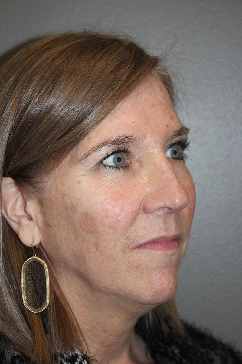 Eyelid surgery Before & After Gallery - Patient 146669148 - Image 9