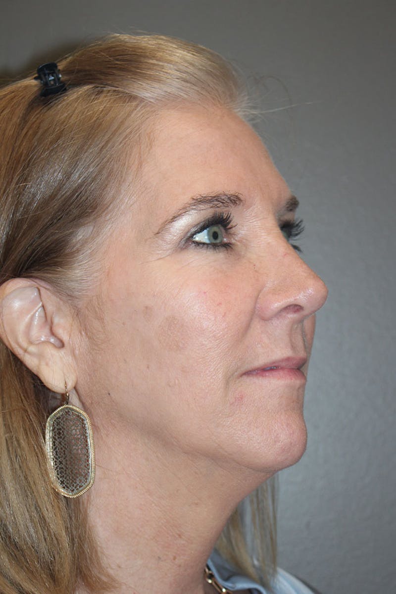 Chemical Peel Before & After Gallery - Patient 146669153 - Image 10