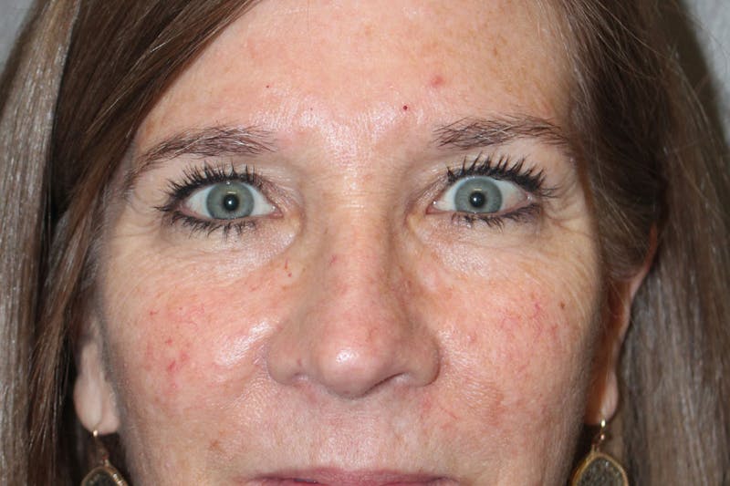 Eyelid surgery Before & After Gallery - Patient 146669148 - Image 11