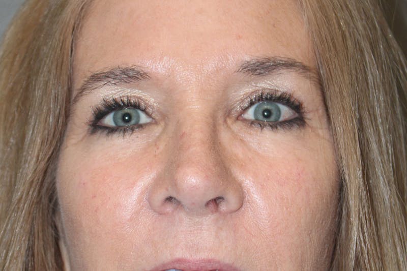 Eyelid surgery Before & After Gallery - Patient 146669148 - Image 12