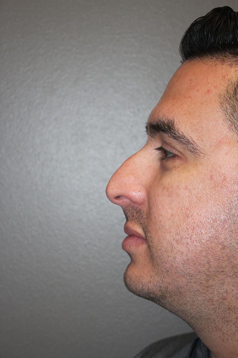 Rhinoplasty Before & After Gallery - Patient 146669562 - Image 7