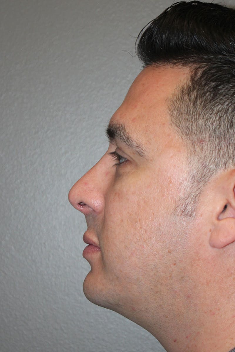 Chin Implant Before & After Gallery - Patient 146669158 - Image 10