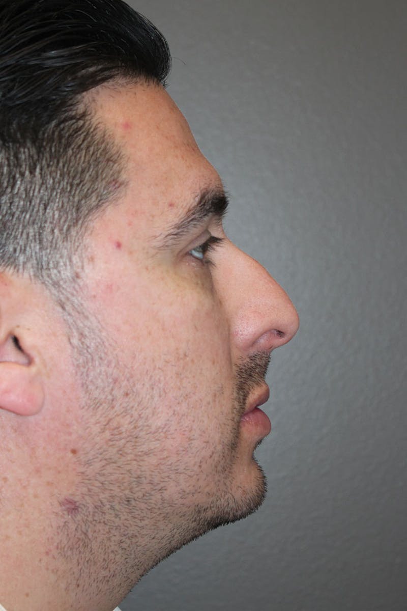 Rhinoplasty Before & After Gallery - Patient 146669562 - Image 1