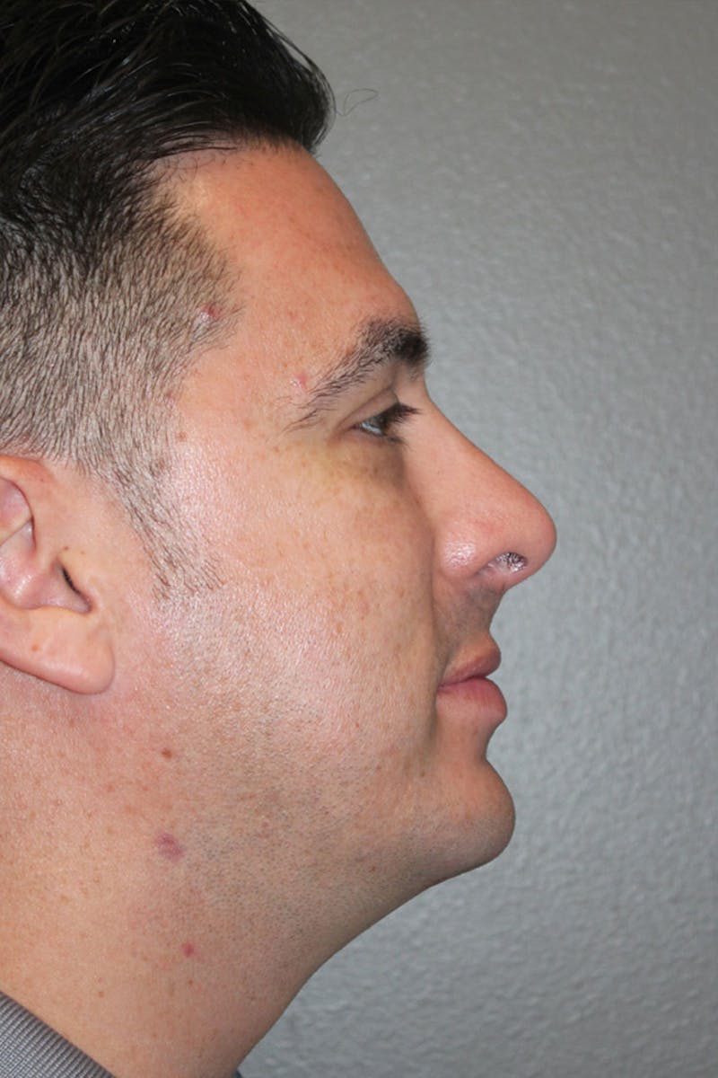 Rhinoplasty Before & After Gallery - Patient 146669562 - Image 2