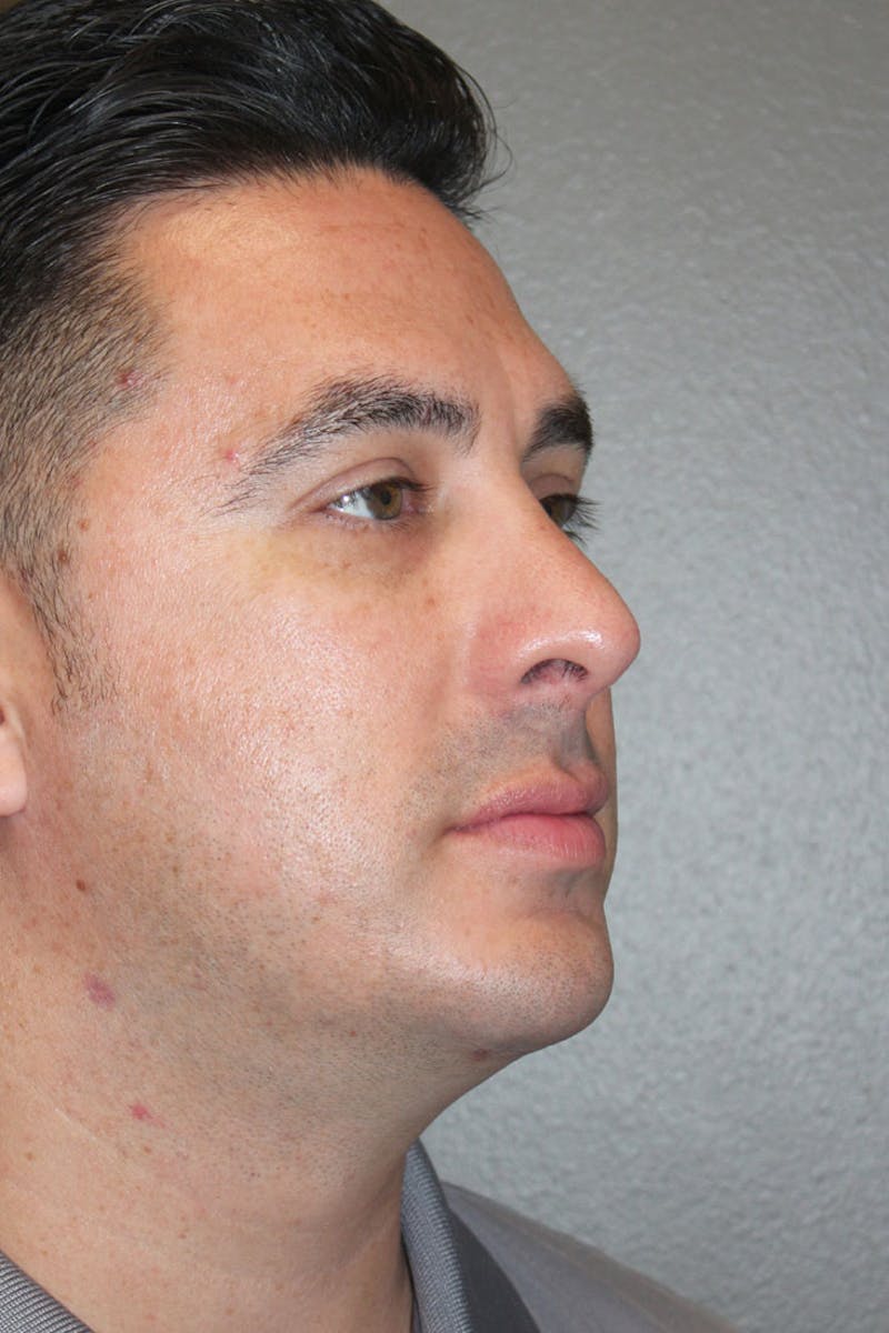 Chin Implant Before & After Gallery - Patient 146669158 - Image 4