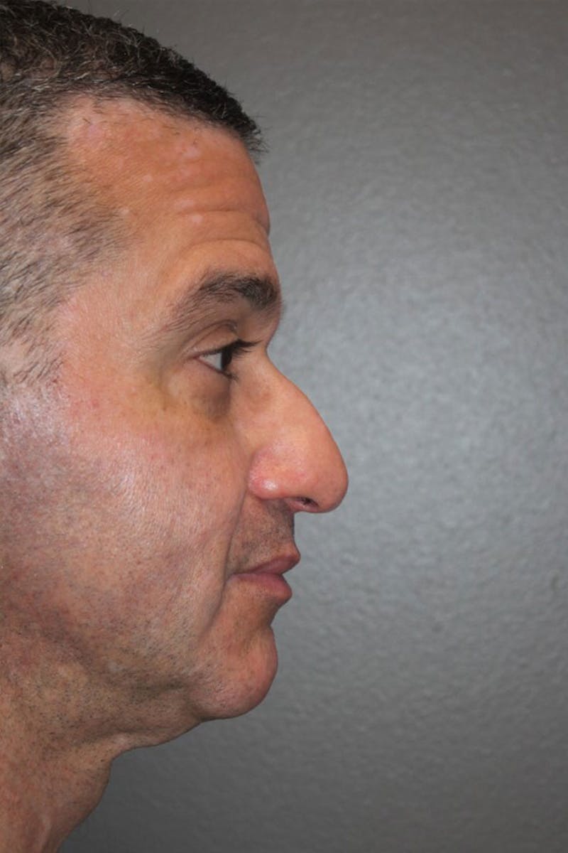 Rhinoplasty Before & After Gallery - Patient 146669176 - Image 1