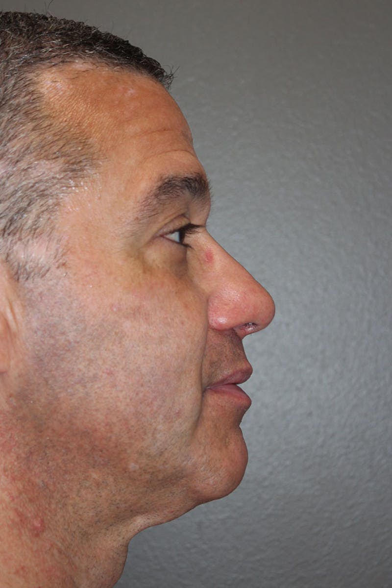 Rhinoplasty Before & After Gallery - Patient 146669176 - Image 2