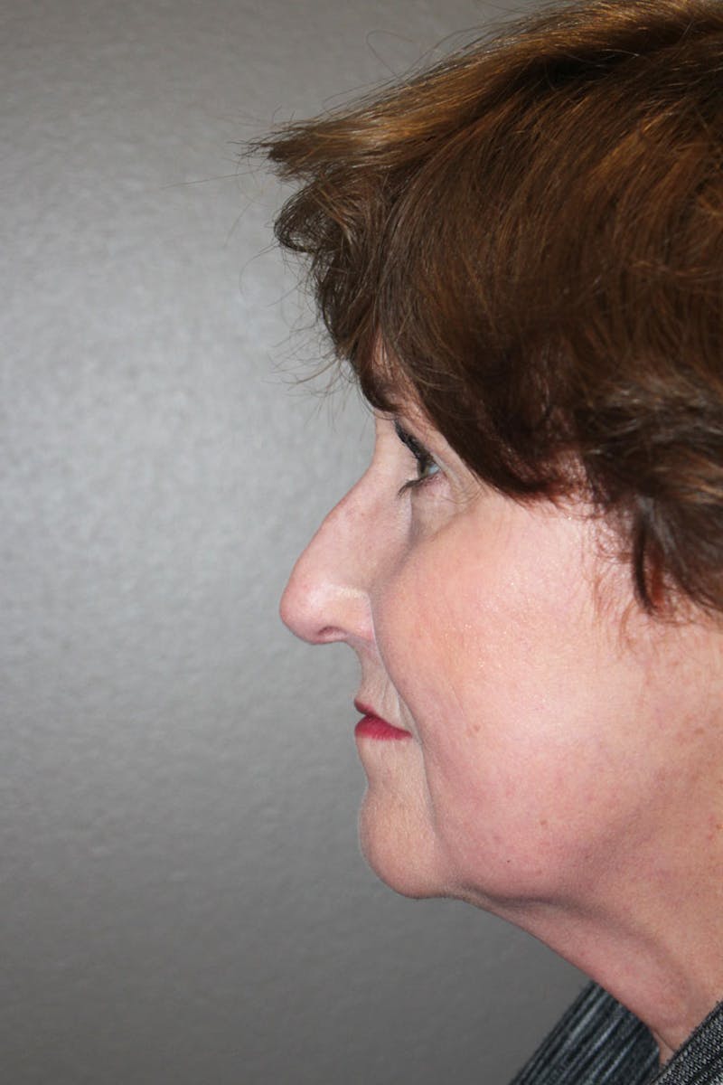 Rhinoplasty Before & After Gallery - Patient 146669175 - Image 7