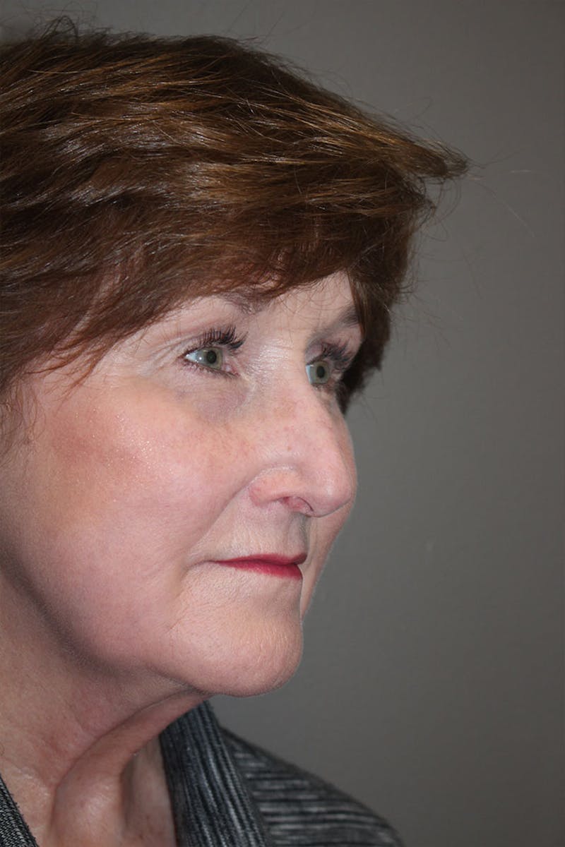 Rhinoplasty Before & After Gallery - Patient 146669175 - Image 9