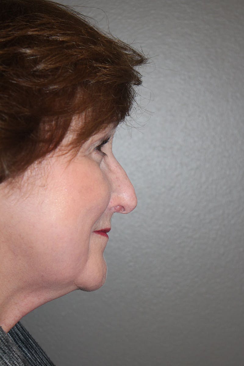 Rhinoplasty Before & After Gallery - Patient 146669175 - Image 1