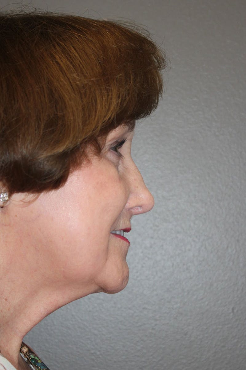 Rhinoplasty Before & After Gallery - Patient 146669175 - Image 2