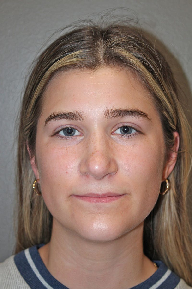 Rhinoplasty Before & After Gallery - Patient 146669316 - Image 4