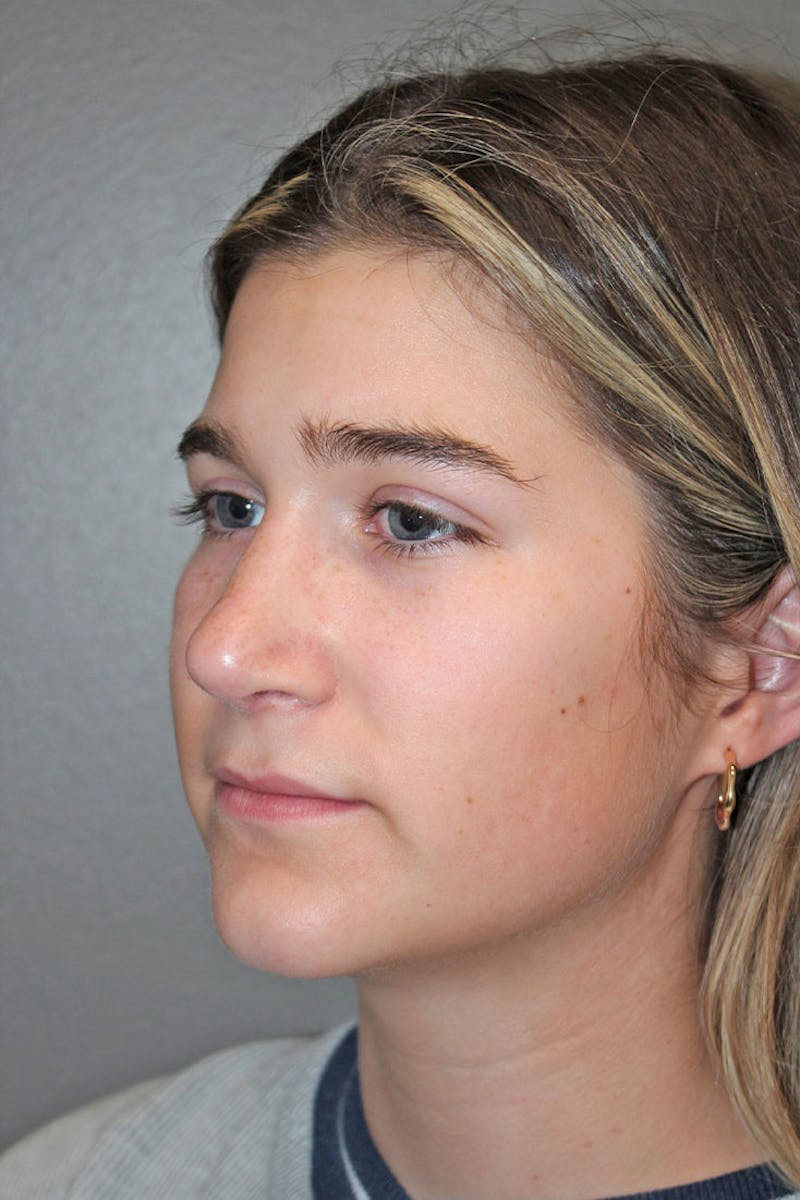 Rhinoplasty Before & After Gallery - Patient 146669316 - Image 6