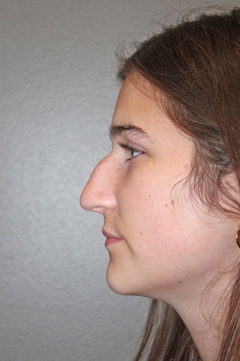 Rhinoplasty Before & After Gallery - Patient 146669316 - Image 7