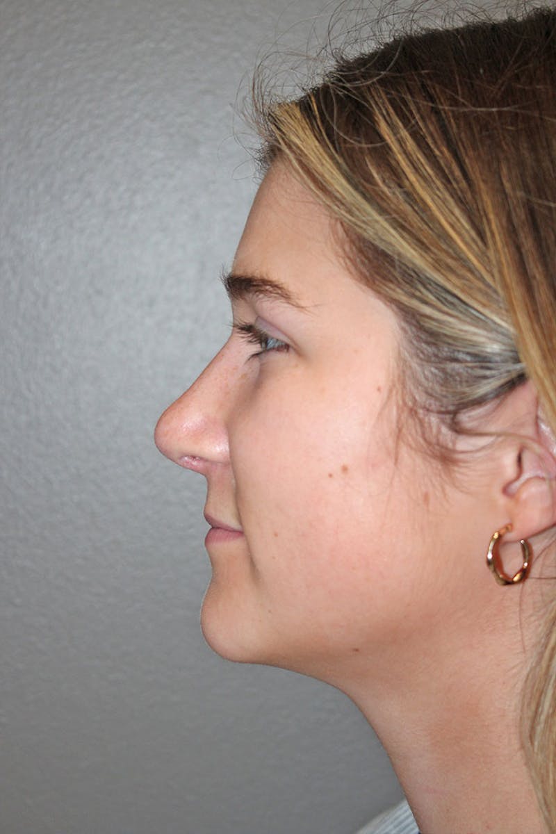 Rhinoplasty Before & After Gallery - Patient 146669316 - Image 8