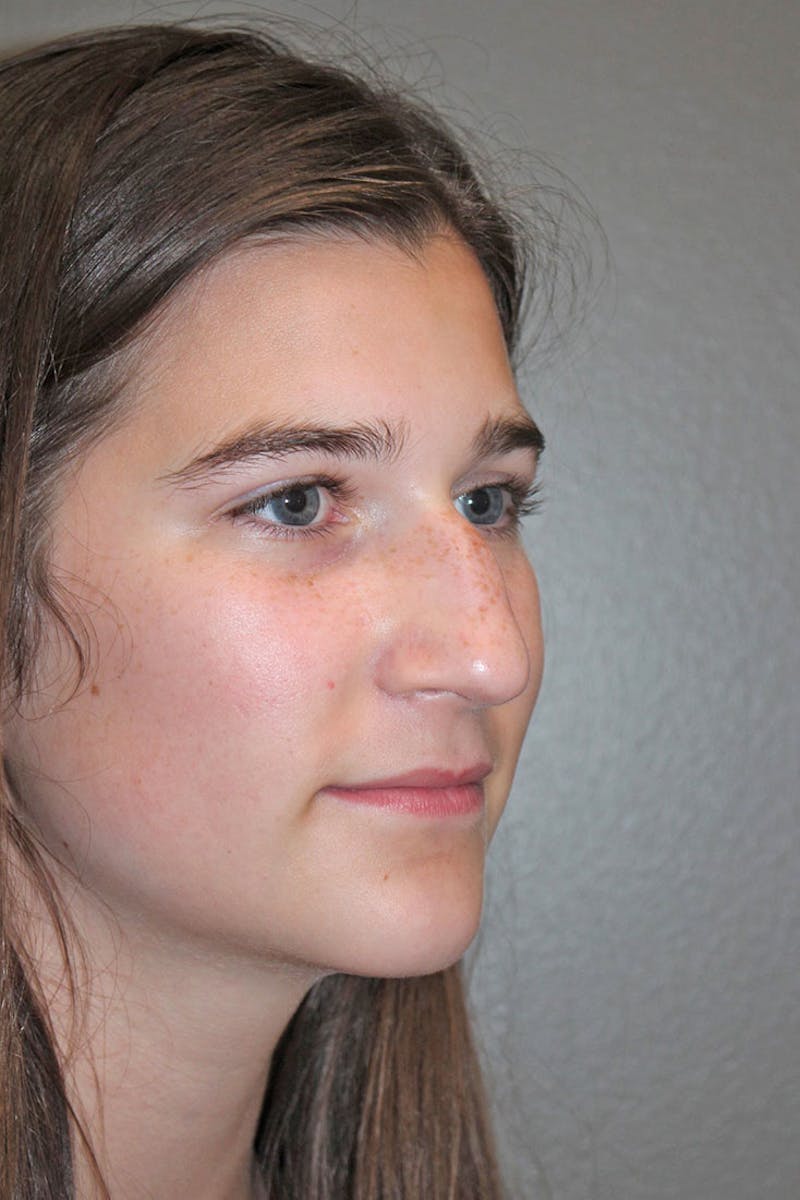 Rhinoplasty Before & After Gallery - Patient 146669316 - Image 9