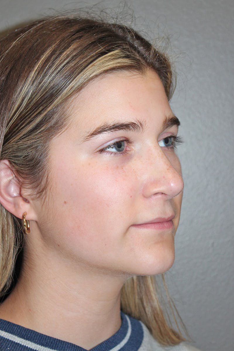 Rhinoplasty Before & After Gallery - Patient 146669316 - Image 10