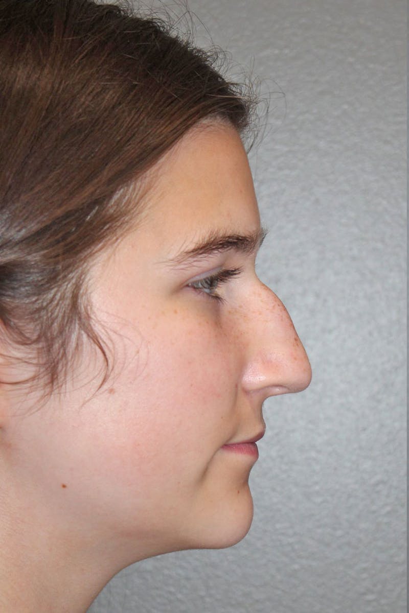 Rhinoplasty Before & After Gallery - Patient 146669316 - Image 1