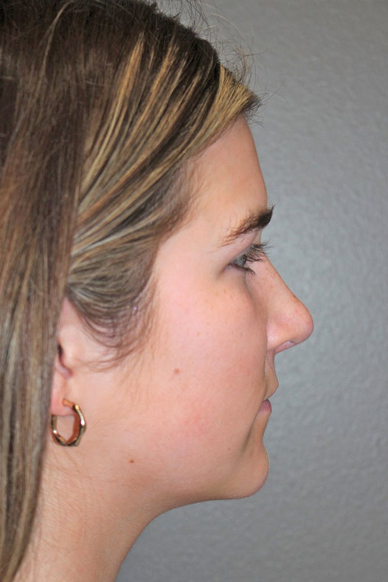 Rhinoplasty Before & After Gallery - Patient 146669316 - Image 2