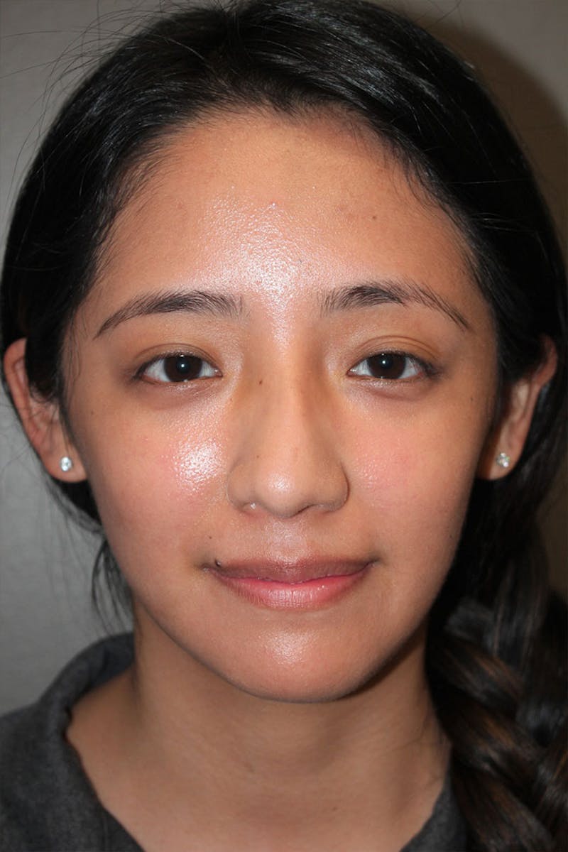 Rhinoplasty Before & After Gallery - Patient 146669315 - Image 3