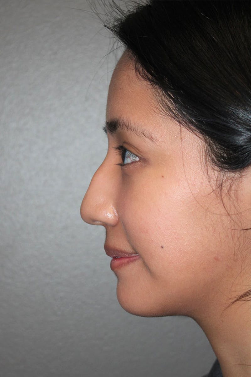 Rhinoplasty Before & After Gallery - Patient 146669315 - Image 5