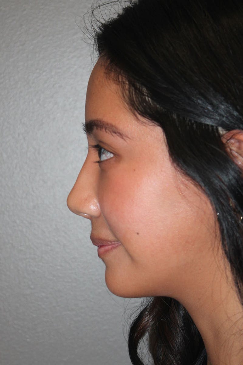 Rhinoplasty Before & After Gallery - Patient 146669315 - Image 6
