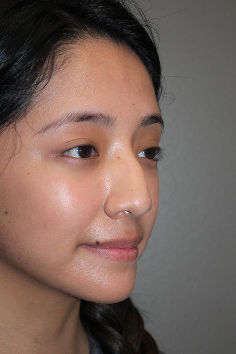 Rhinoplasty Before & After Gallery - Patient 146669315 - Image 7