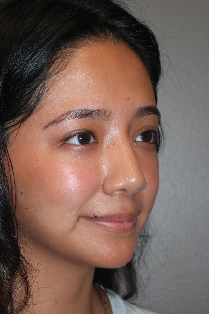 Rhinoplasty Before & After Gallery - Patient 146669315 - Image 8