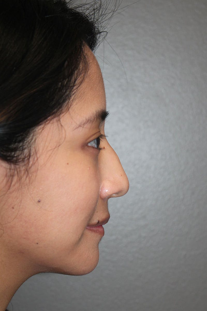 Rhinoplasty Before & After Gallery - Patient 146669315 - Image 1