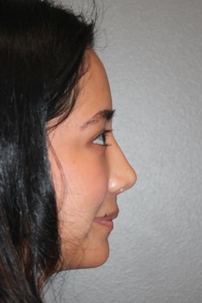 Rhinoplasty Before & After Gallery - Patient 146669315 - Image 2