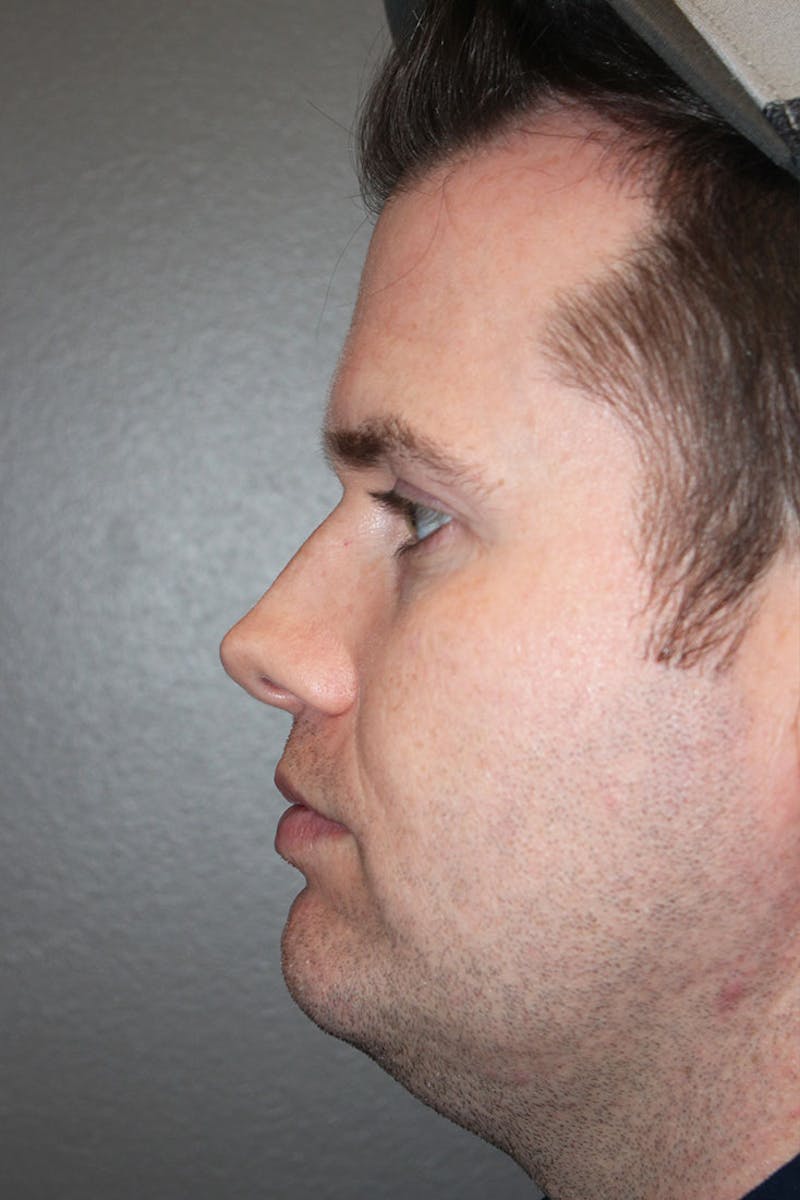 Rhinoplasty Before & After Gallery - Patient 146669493 - Image 5