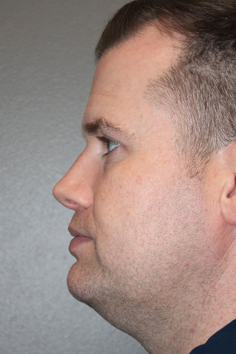 Rhinoplasty Before & After Gallery - Patient 146669493 - Image 6