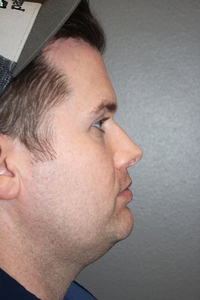Rhinoplasty Before & After Gallery - Patient 146669493 - Image 1