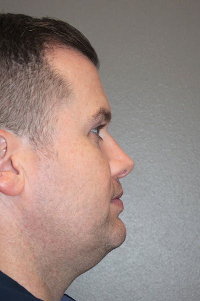 Rhinoplasty Before & After Gallery - Patient 146669493 - Image 2