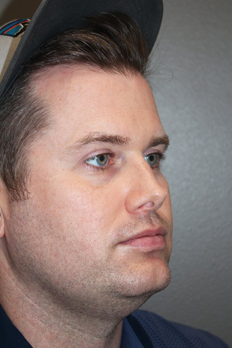 Rhinoplasty Before & After Gallery - Patient 146669493 - Image 9
