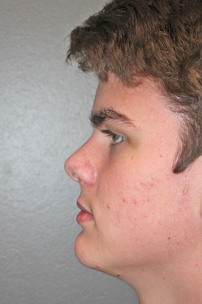 Rhinoplasty Before & After Gallery - Patient 146669492 - Image 7